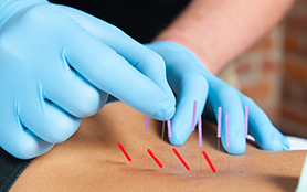 Dry needling